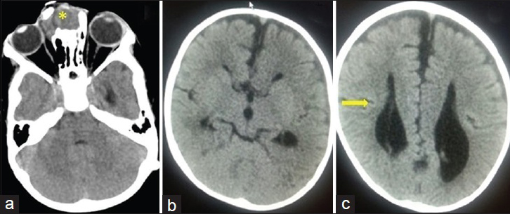 3-year-old male child with a swelling at nasal bridge, (a) axial computed tomography scan shows a nasofrontal encephalocele (*), (b and c) axial computed tomography sections show corpus callosal agenesis as evidenced by parallel running lateral ventricles with colpocephaly (arrow → in c).