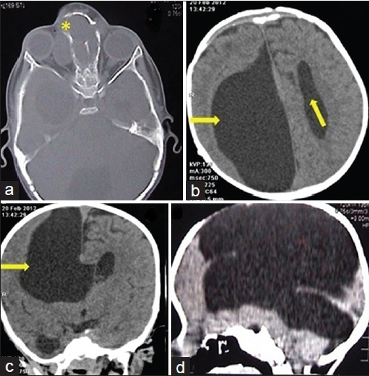 2-year-old male child with a forehead swelling, (a) axial computed tomography bone window shows nasoethmoidal and naso-orbital type of encephalocele (*). (b) Axial, (c) coronal and (d) sagittal computed tomography sections show associated large hemispheric arachnoid cyst (arrow→). (b) Axial CT section also reveals the parallel orientation left lateral ventricle (upward arrow ↑) suggestive of corpus callosal agenesis.