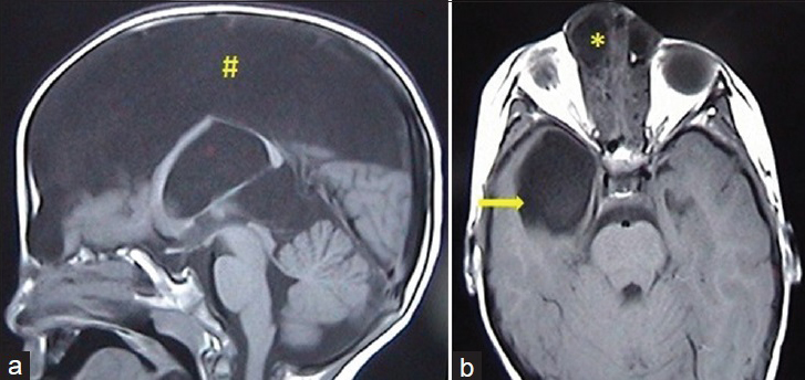 2-year-old female child with swelling at nasal bridge, (a) sagittal T1-weighted image shows a large interhemispheric arachnoid cyst (#). (b) Axial T1-weighted image in another patient with nasoethmoidal encephalocele (*) shows an arachnoid cyst in right temporal fossa (arrow→).