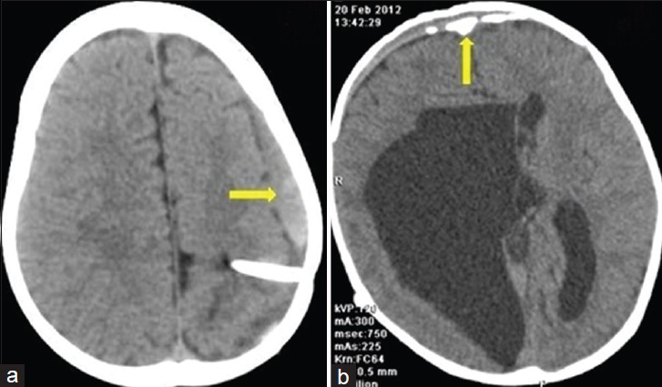 2-year-old female child with forehead swelling, (a) axial computed tomography section shows left subdural collection (arrow→) in a patient with ventriculoperitoneal shunt. (b) Axial computed tomography section in another patient with a large arachnoid cyst showing bilateral frontal subdural collection (arrow) with calcification of the arachnoid membrane.