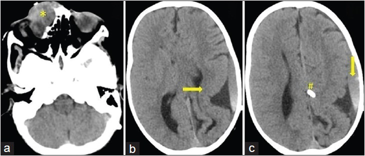 4-year-old child presented with swelling over the nose and seizure, (a) axial computed tomography scan shows nasofrontal type of encephalocele (*) with mild orbital extension. (b) Axial computed tomography section also shows agyria and pachygyria complex involving left parietooccipital lobe (arrow →) with corpus callosal agenesis. (c) Higher axial computed tomography section also shows ventriculoperitoneal shunt (#) in interhemispheric fissure with left subdural collection (arrow).