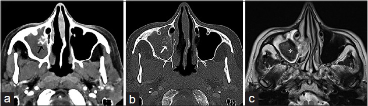 A 65-year-old female, who presented with a history of chronic sinusitis, headaches, and facial discomfort, is diagnosed with a mycetoma. Contrast computer tomography scan of the face in axial view in (a) soft tissue and (b) bone algorithm show complete opacification of the right maxillary sinus with intralesional calcification (arrows) and reactive osteitis, indicative of chronic sinusitis. (c) Corresponding T2-weighted magnetic resonance imaging of the face in axial view shows a low attenuating mass in the right maxillary sinus with surrounding mucosal thickening, consistent with a mycetoma (asterisk).