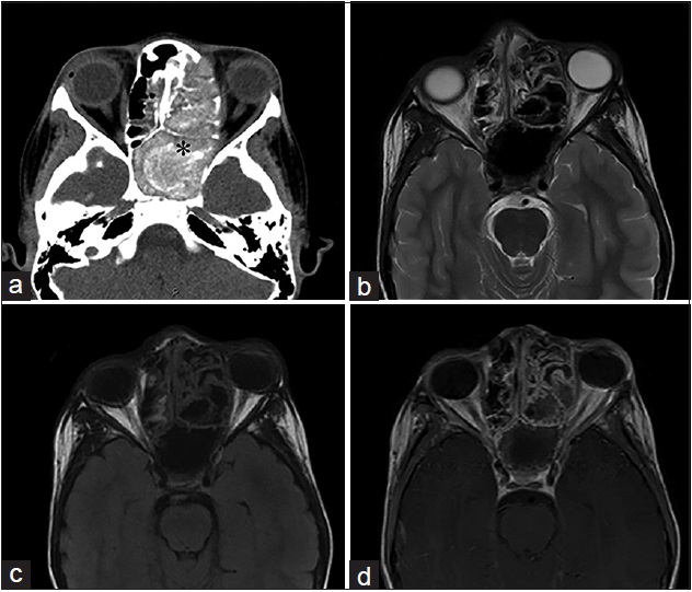 An 11-year-old male, who presented with rhinorrhea and a 2-month history of “left eye swelling,” is diagnosed with allergic fungal sinusitis (Curvularia Sp). (a) Noncontrast computed tomography of the head in axial view shows opacification of the left ethmoid and sphenoid sinuses, with internal hyperattenuating material and expansion and remodeling of the involved sinuses (asterisk). (b) T2-weighted and (c) T1-weighted magnetic resonance imaging of the face in axial view demonstrates the low signal intensity of the mucin due to high concentrations of various metals metabolized by the fungus and a high protein and low free water content. (d) Corresponding T1-weighted postgadolinium magnetic resonance imaging of the face in axial view demonstrates a hyperintense inflamed mucosal lining. No enhancement of the sinus cavity or its contents allows a differentiation from neoplastic entities.