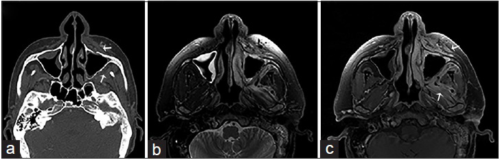 A 44-year-old male, who presented with gradually increasing left jaw swelling and pain over the course of 2 weeks, is diagnosed with acute invasive zygomycosis. The patient had a history of hepatitis C and alcoholic liver cirrhosis. (a) Contrast-enhanced computed tomography scan of the face in the bone algorithm, axial view shows mucosal thickening of the maxillary sinuses with the erosion of the left maxillary bone (anterior and posterior walls) and obliteration of the periantral fat planes in the premaxillary and masticator spaces (arrows). (b) Magnetic resonance imaging T2-weighted and (c) gadolinium-enhanced T1-weighted fat saturated imaging of the face in axial view shows inflammatory changes and contrast enhancement in the described periantral planes and masticator muscles due to fungal invasion (arrows).