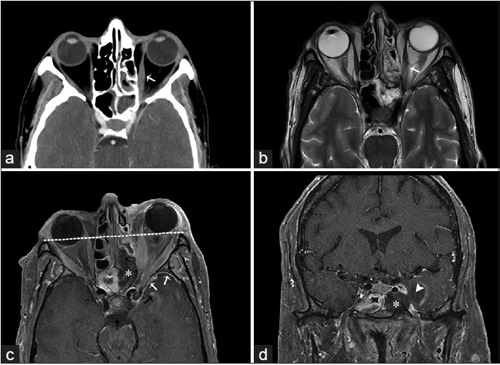 A 55-year-old male, who presented with headaches, rhinorrhea, vision loss, and acute myelogenous leukemia, is diagnosed with acute invasive aspergillosis. (a) Computed tomography scan with contrast and (b) T2-weighted magnetic resonance imaging of the face in axial view demonstrate inflammation of the left ethmoidal and sphenoid sinuses with thickening of the left medial rectus muscle due to intraorbital extension (arrows). T1-weighted fat saturated postgadolinium magnetic resonance imaging of the face in axial (c) and coronal (d) view shows absence of enhancement of the left posterior ethmoid and sphenoid sinus mucosa indicative of gangrenous necrosis (asterisk), intraorbital extension resulting in proptosis (line), intracranial extension through the partially thrombosed left cavernous sinus with abnormal leptomeningeal (black arrow) and pachymeningeal enhancement (white arrows), and abscess formation in the left temporal fossa (arrowhead).