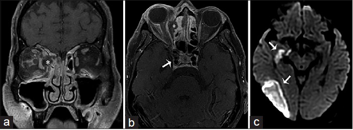 A 63-year-old female, who presented with altered mental status, decreased vision and left-sided weakness of the face and arm, and a history of sinusitis and uncontrolled type 2 diabetes mellitus, is diagnosed with rhino-orbital-cerebral-zygomycosis (mucormycosis). T1-weighted fat saturated postgadolinium images of the brain in (a) coronal and (b) axial view shows ethmoidal sinusitis with bone erosion and a subperiosteal abscess (asterisk) occupying the medial aspect of the right orbit and displacing the medial rectus muscle laterally and extension to the right cavernous sinus with internal carotid artery invasion (arrow in b). (c) Diffusion-weighted imaging demonstrates an acute infarct in the territory of the right middle cerebral artery (arrows).