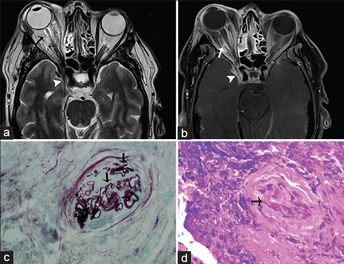 A 41-year-old male, who presented with chronic sinusitis, decreased vision, swelling of the right eye, and numbness of the face, is diagnosed with mucormycosis. The patient had a history of poorly controlled diabetes mellitus. (a) Axial T2-weighted and (b) corresponding T1-weighted fat saturated postgadolinium magnetic resonance imaging of the head in axial view shows inflammatory thickening of the ethmoidal sinus (asterisk) with expansion and dehiscence of the right orbital wall and marked inflammatory changes of the orbital fat and extraocular muscles (arrows) indicative of ocular invasion and resulting in ipsilateral proptosis. Inflammatory changes are extending through the orbital apex and right cavernous sinus (arrowhead) (c) Gomori methenamine silver stain outlines mucorales fungal microorganisms (arrows) (d) high power view of the ethmoid tissue shows mucorales of fungal microorganisms (arrow) involving blood vessels (H and E).