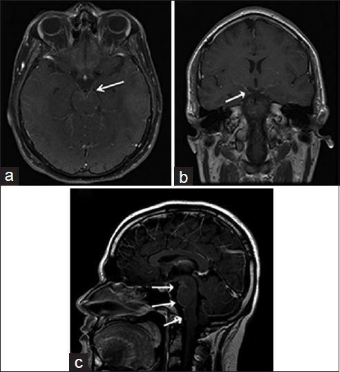 A 22-year-old immunocompetent man, who presented with headaches, is diagnosed with coccidioidal meningitis. Magnetic resonance imaging T1-weighted postcontrast imaging of the brain in axial (a), coronal (b) and sagittal (c) view shows marked supra- and infra-tentorial smooth linear leptomeningeal enhancement (white arrows) is consistent with meningitis.