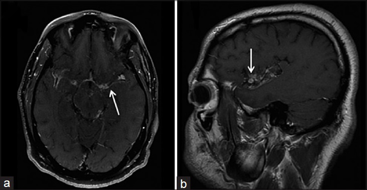 A 40-year-old immunocompetent man, who presented with headaches and had a history of disseminated coccidioidomycosis, is diagnosed with granulomatous leptomeningitis. Magnetic resonance imaging T1-weighted postcontrast imaging of the brain in axial (a) and sagittal (b) view shows nodular, irregular and intense leptomeningeal enhancement (arrows) involving the sylvian fissure. These findings are consistent with granulomatous leptomeningitis.