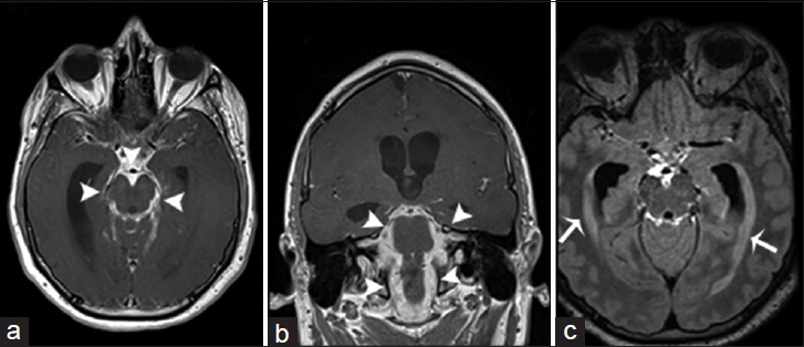 A 25-year-old man, who presented with a history of acute daily headaches over the past 6 months and had a history of chronic coccidioidal meningitis (treated), is diagnosed with chronic hypertrophic basal arachnoiditis and secondary hydrocephalus. Magnetic resonance imaging T1-weighted postcontrast imaging of the brain in axial (a) and coronal (b) view demonstrates marked leptomeningeal hypertrophy with diffuse enhancement involving predominantly the basal cisterns (arrowheads). (c) Magnetic resonance imaging fluid-attenuated inversion recovery postcontrast imaging of the brain in axial view shows a significant enlargement of the lateral ventricles with transependymal migration of cerebrospinal fluid (arrows). These findings are consistent with a hydrocephalus secondary to chronic hypertrophic basal arachnoiditis.