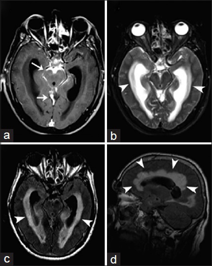 A 60-year-old woman, who presented with headaches, is diagnosed with coccidioidal basal arachnoiditis and acute communicating hydrocephalus. (a) Magnetic resonance imaging T1-weighted postcontrast imaging of the brain in axial view shows abnormal leptomeningeal thickening and enhancement along the perimesencephalic and superior cerebellar cisterns (arrows). (b) Magnetic resonance imaging T2-weighted imaging of the brain in axial view and magnetic resonance imaging fluid-attenuated inversion recovery (c and d) of the brain in axial and sagittal view demonstrate supratentorial ventriculomegaly associated with effacement of the cortical sulci and transependymal edema (arrowheads). These findings are consistent with basal arachnoiditis and acute communicating hydrocephalus.