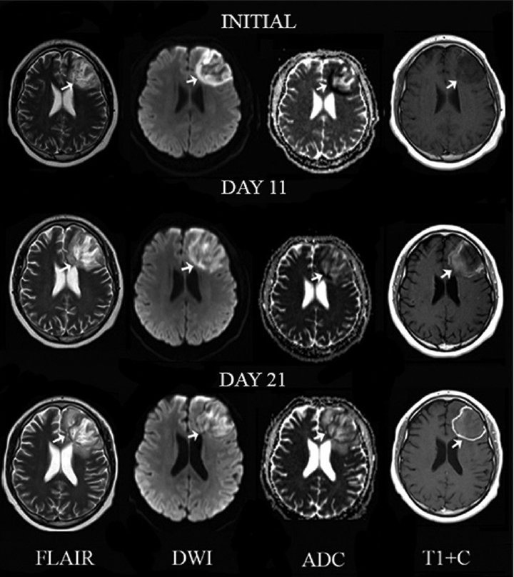 A 17-year-old man with headaches and lymphoma diagnosed with Aspergillus fumigatus infection of the central nervous system. Serial magnetic resonance imaging of a left frontal lobe lesion (arrows) on T2, diffusion-weighted imaging, apparent diffusion coefficient map and T1 postcontrast (T1 + C) from left to right in axial view. Initially, the lesion appears ill-defined with increased signal intensity with foci of signal void on T2, restricted diffusion on diffusion-weighted imaging and apparent diffusion coefficient map and no abnormal enhancement on T1 post contrast suggesting late cerebritis. An 11-day follow-up shows decrease of signal voids on T2, restricted diffusion on diffusion-weighted imaging and faint peripheral enhancement on T1 post contrast consistent with early capsulitis. A 21-day follow-up demonstrates development of well-defined borders and linear peripheral enhancement on T1 post contrast consistent with late capsulitis.
