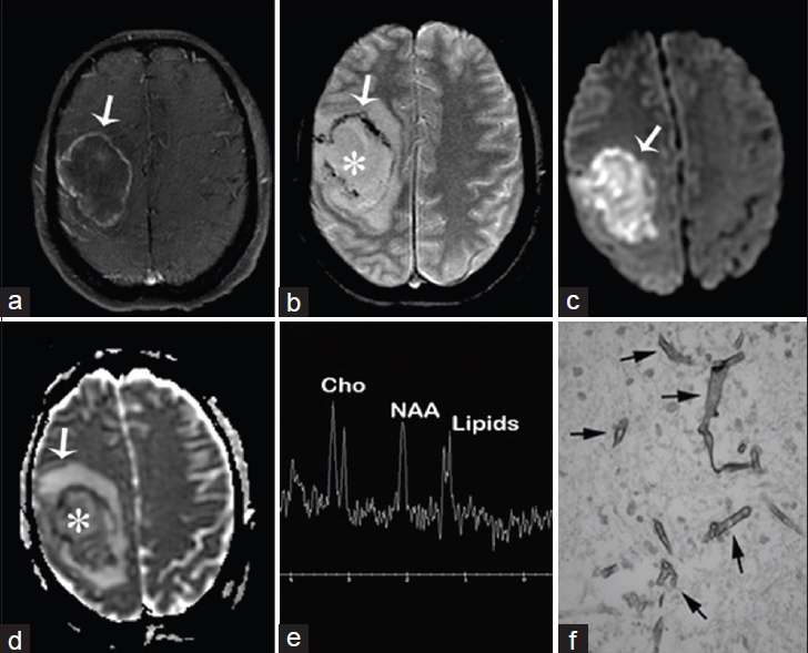 A 50-year-old woman with acute myeloid leukemia, fever, headaches, and neurologic deficits diagnosed with brain abscess due to Rhizomucor pusillus (a) Magnetic resonance imaging T1 fast spin echo/fat sat postcontrast of the brain, axial view shows right sided mass with enhancing wall (arrow) (b) magnetic resonance imaging T2* GRE, axial view shows nonenhancing liquefied core (asterisk) and hypointense wall with susceptibility artifact (arrow) (c and d) diffusion-weighted imaging and apparent diffusion coefficient map of the brain, axial view show restricted diffusion of the wall and intracavitary projections (arrows) and no restriction inside the lesion (asterisk d) (e) MR spectroscopy of the brain shows inverted NAA/Cho ratio due to NAA depletion and increased lipids due to cell destruction (f) Gomori methenamine silver nitrate stain shows Zygomycetes (arrows).