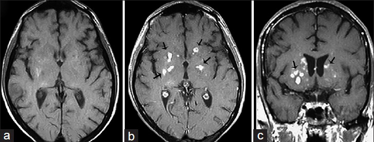 A 38-year-old immunocompromised male presenting with headache and altered mental status diagnosed with Cryptococcosis (a) Magnetic resonance imaging T1-weighted imaging of the head in axial view, T1 postcontrast-weighted imaging of the head in axial (b) and coronal view (c) reveal multiple small enhancing nodules in the basal ganglia bilaterally within perivascular spaces consistent with cryptococcomas (arrows).