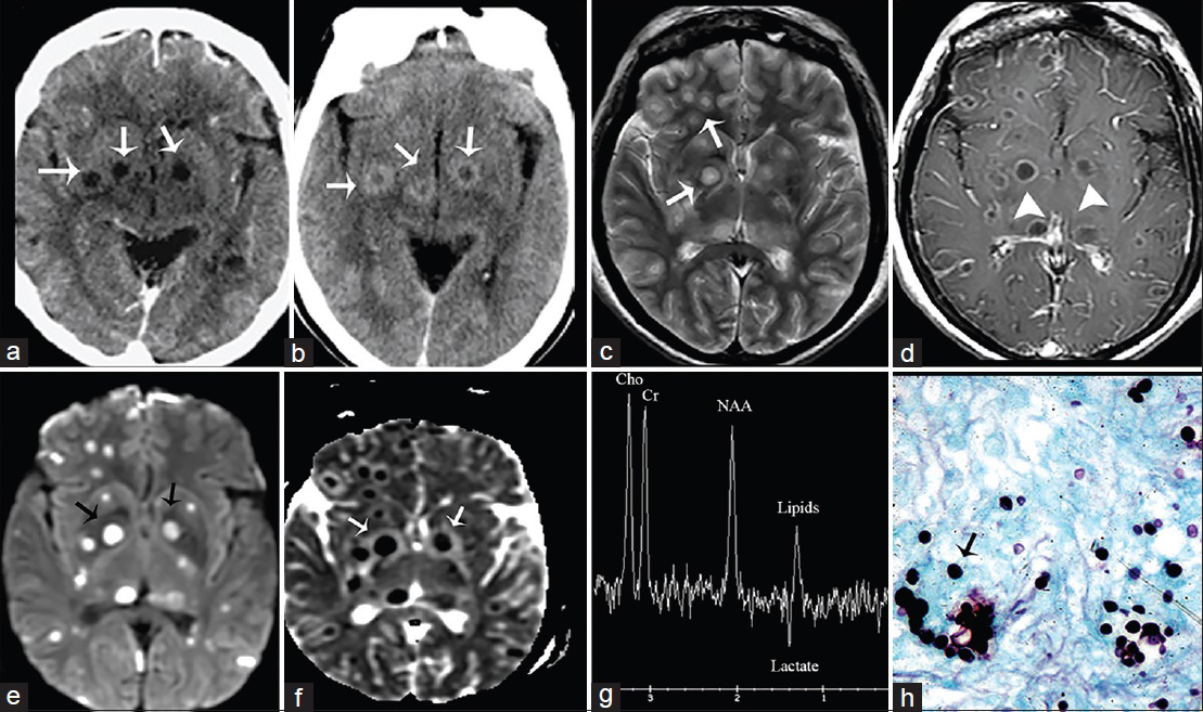 A 52-year-old woman, human immunodeficiency virus-positive with neurological deficits diagnosed with central nervous system cryptococcosis. (a) Noncontrast and (b) contrast-enhanced computed tomography scan of the brain, axial view show rim enhancing lesions in the basal ganglia (arrows). (c) Magnetic resonance imaging T2, axial view demonstrates increased signal intensity in the lesions. (Gelatinous pseudocysts) (arrows). (d) Magnetic resonance imaging T1 postcontrast shows rim enhancement (arrowheads), (e) B1000 data set and corresponding ADC map (f) show restricted diffusion (arrows). (g) MR spectroscopy shows inverted NAA/Cho ratio with lipids and lactate consistent with infection (h) GSM stain shows fungal organism (arrow).