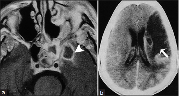 A 51-year-old man, who presented with right-sided paresis and had a history of uncontrolled diabetes mellitus, is diagnosed with chronic invasive fungal Mucormycosis. (a) Magnetic resonance imaging T1 postcontrast imaging of the brain in axial view demonstrates an infectious process in the left sphenoidal sinus and an intracranial intraparenchymal ring enhancing extension in the medial temporal lobe indicative of an abscess (arrowhead). (b) Contrast-enhanced computer tomography image of the same patient shows and acute infarct in the vascular territory of the left middle cerebral artery secondary to intracranial vasculitis (arrow).