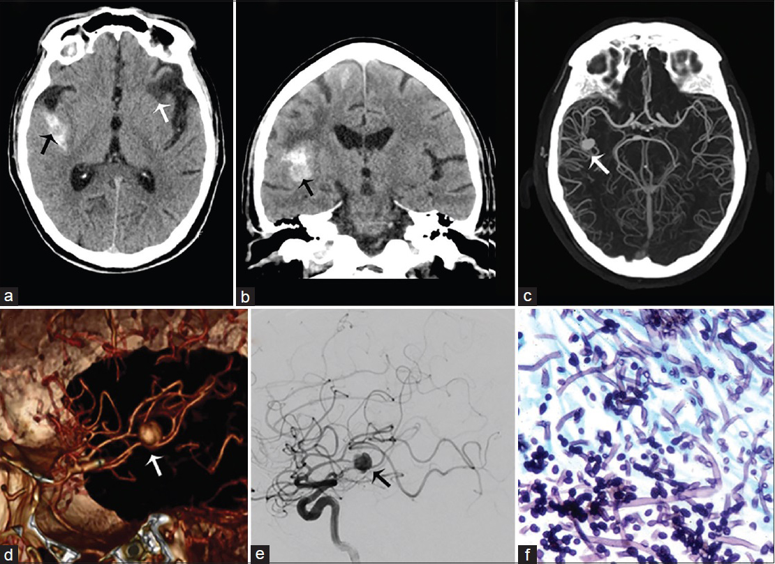 A 55-year-old man with history of intravenous drug abuse, headache, and sepsis due to a Candida sp. infection, diagnosed with mycotic aneurysm of the M2–M3 right middle cerebral artery. Computed tomography imaging of the brain without contrast in axial (a) and coronal (b) view demonstrate subarachnoid hemorrhage in the right lateral fissure surrounding right middle cerebral artery aneurysm (black arrow) and areas of encephalomalacia of prior ischemic events (white arrow). (c) Maximum intensity projection computed tomography angiogram, (d) three-dimensional reconstruction and (e) lateral selective angiogram show a saccular aneurysm arising from the M2–M3 right middle cerebral artery (arrows). (f) H and E stain with hyphae of Candida albicans.