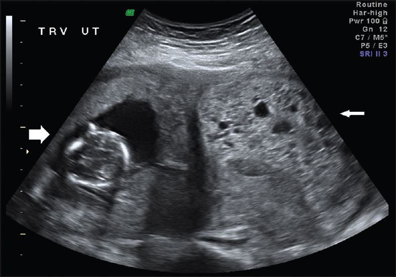 A 40-year-old female with a known bicornuate uterus and twin pregnancy. Transvaginal ultrasonography demonstrates a transverse cross-sectional view of a bicornuate uterus with a viable intrauterine pregnancy in the right horn (thick arrow on the left of the image) and a molar gestation in the left horn (thin arrow on the right of the image).