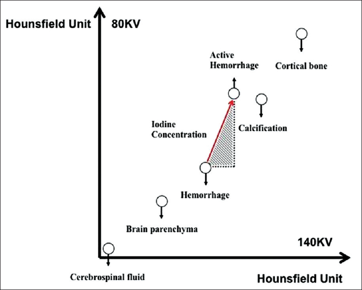 Principle of material decomposition algorithm is based on the different attenuation profiles of brain parenchyma, hematoma, and iodine. Measured voxel values are plotted on the dual-energy scatterplot. Cerebrospinal fluid, brain parenchyma, and hematoma show similar Hounsfield unit value on both 80 and 140 kV images. In contrast, iodine shows a two-fold increase in Hounsfield unit value on 80 kV compared with 140 kV. The gradient of the slope (red arrow) correlate with the iodine concentration and increased gradient reflect greater concentration of iodine.