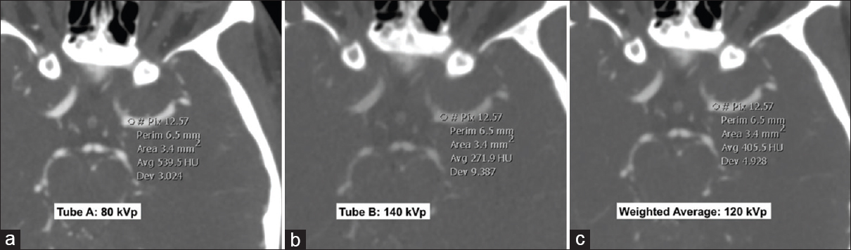 Dual-energy computed tomography angiogram at 80 kVp (a), 140 kVp (b) and weighted average image (c) simulating a 120 kVp image. All the three images displayed are at the same window width and level. Differences in the Hounsfield unit attenuation between the images are illustrated by the Hounsfield unit measurements within the left middle cerebral artery. The lowest energy 80 kVp image (a) shows greatest Hounsfield unit as the energy level is closer to the k-edge of iodine. In contrast, the highest energy 140 kVp image (b) shows lowest Hounsfield unit.