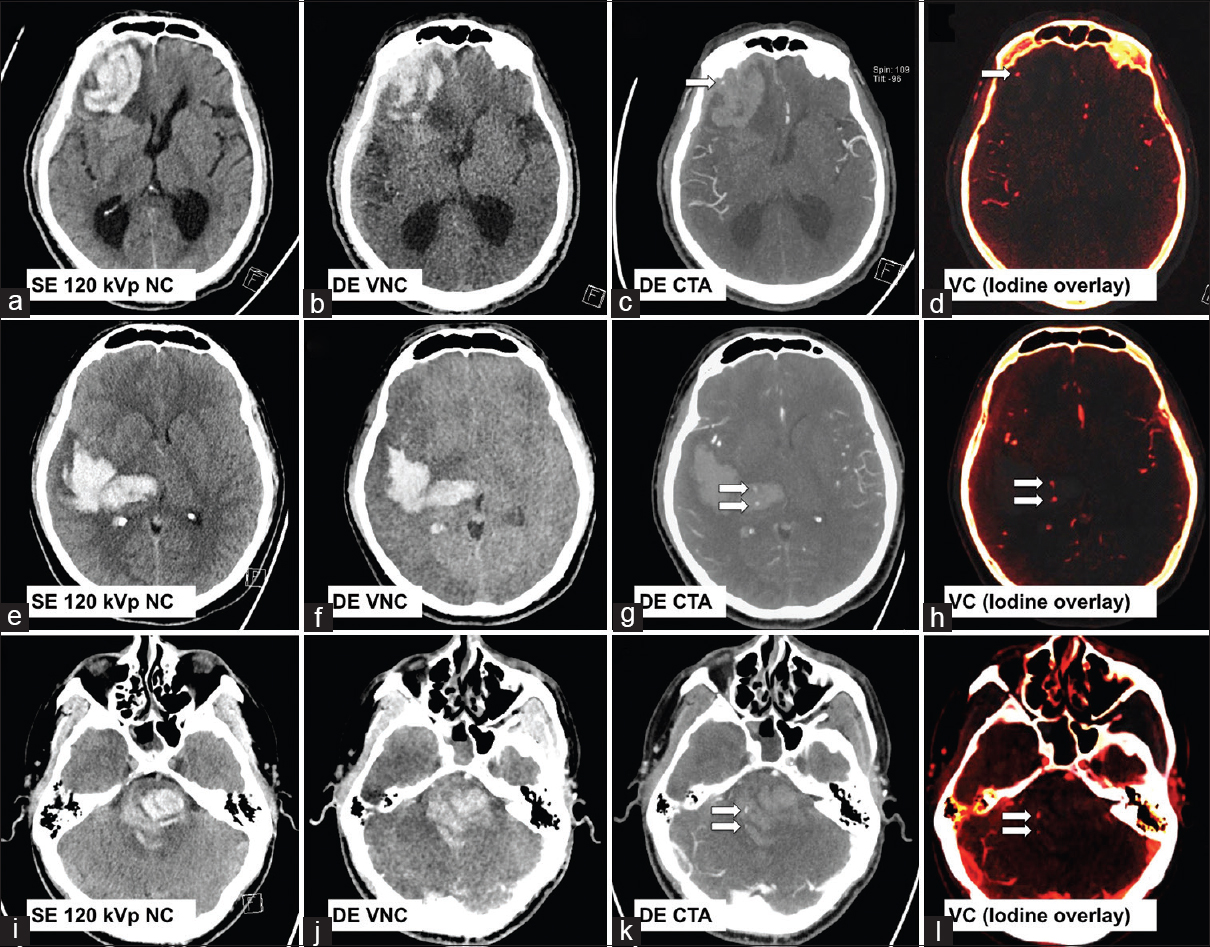 Three examples of cerebral hematoma with active hemorrhage as depicted by a positive “spot sign(s) (arrows) on dual-energy computed tomography angiogram and virtual contrast images. First row: A 78-year-old male with known cerebral amyloid angiopathy (a-d). Second row: A 50-year-old female with poorly controlled hypertension (e-h). Third row: A 26-year-old male with amphetamine abuse (i-l).