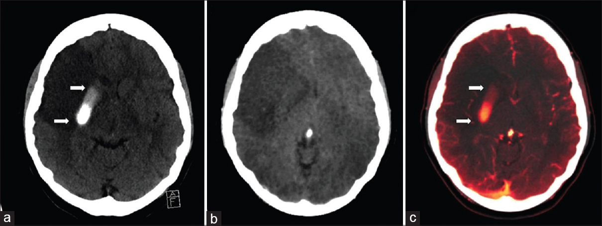 Noncontrast computed tomography of the head (a) shows a focal intraparenchymal hyperdensity in the right lenticular nucleus in a patient following failed clot retrieval for the right middle cerebral artery stroke. Dual-energy computed tomography cerebral angiogram virtual noncontrast image (b) shows subtraction of the right lenticular nucleus hyperdensity (arrows). Virtual contrast image (c) confirms the hyperdensity (arrows) that represents contrast staining. The graduated appearance of the contrast staining may be due to layering/sedimentation.