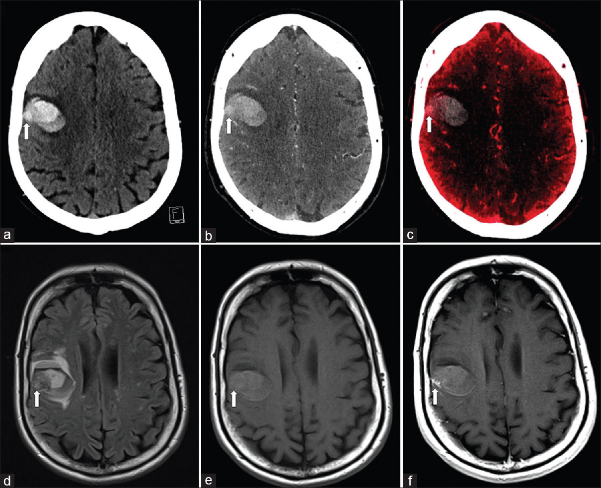 A 50-year-old woman with melanoma metastasis. Single-energy noncontrast computed tomography image (a) shows acute intraparenchymal hemorrhage in the right frontal lobe with a suspicious juxtacortical lesion (arrow) which is difficult to differentiate from surrounding acute hemorrhage. Computed tomography cerebral angiogram (b) again depicts subtle enhancement of the suspected juxtacortical lesion (arrow). Virtual contrast image (c) confirms the presence of a juxtacortical lesion (arrow). Concurrent magnetic resonance imaging brain fluid-attenuated inversion recovery (d), pre- and post-contrast T1-weighted images (e and f) confirms the presence of an enhancing juxtacortical lesion.