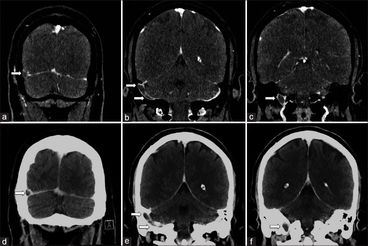 A 38-year-old female with extensive right dural venous sinus thrombosis. Dual-energy computed tomography venogram with bone subtraction images (a-c) shows extensive right dural venous sinus thrombosis involving the distal transverse sinus, sigmoid sinus, and proximal internal jugular vein (arrows). Dual-energy computed tomography venogram without bone subtraction images (d-f) provided for comparison showing the dural venous thrombosis is less conspicuous, especially at the skull base (arrows).