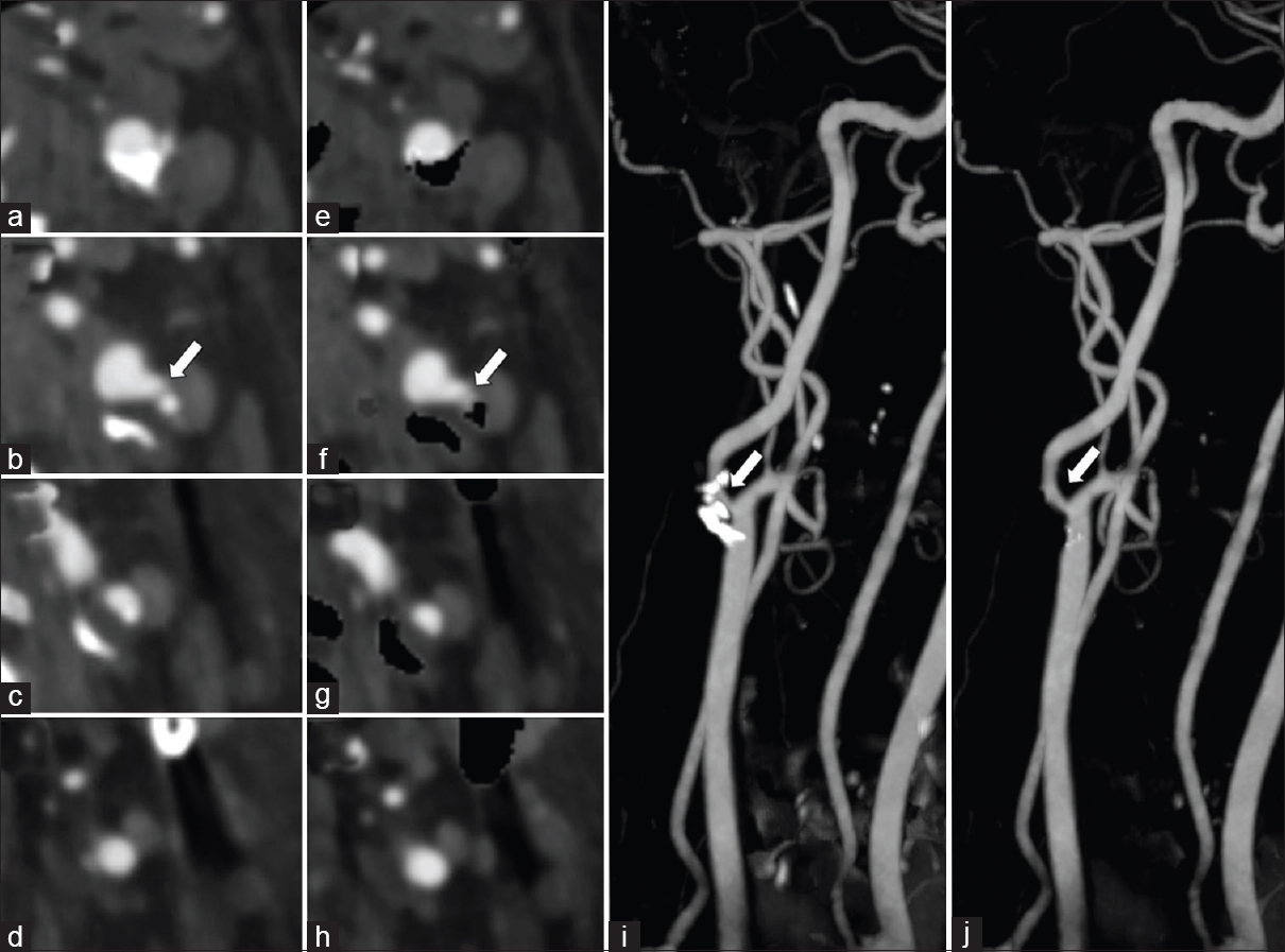 A 60-year-old male with symptomatic left carotid artery stenosis. Dual-energy computed tomography neck angiogram axial images (a-d) and with automatic hard plaque subtraction (e-h) shows moderate-to-high grade stenosis of the right proximal internal carotid artery by hard plaque (arrow). Note the automatic hard plaque subtraction images (e-h) better depict the degree of luminal stenosis than standard axial images (a-d). Rotating maximum intensity projections image (i) and with automatic hard plaque subtraction (j) shows clear visualization of the internal carotid artery which is otherwise obscured by the hard plaque (arrow).