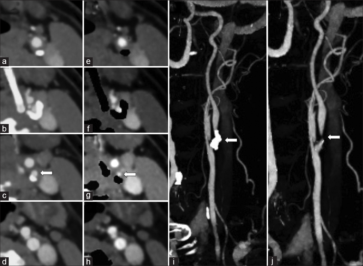 A 67-year-old female with symptomatic left carotid artery stenosis. Dual energy-computed tomography neck angiogram axial images (a-d) and with automatic hard plaque subtraction (e-h) shows high-grade stenosis of the left proximal internal carotid artery by a circumferential hard plaque (arrow). Note the automatic hard plaque subtraction image overestimated the degree of stenosis when compared to the standard axial image. Rotating maximum intensity projections image (i) and with automatic hard plaque subtraction (j) shows the proximal internal carotid artery which is otherwise obscured by the hard plaque (arrow).