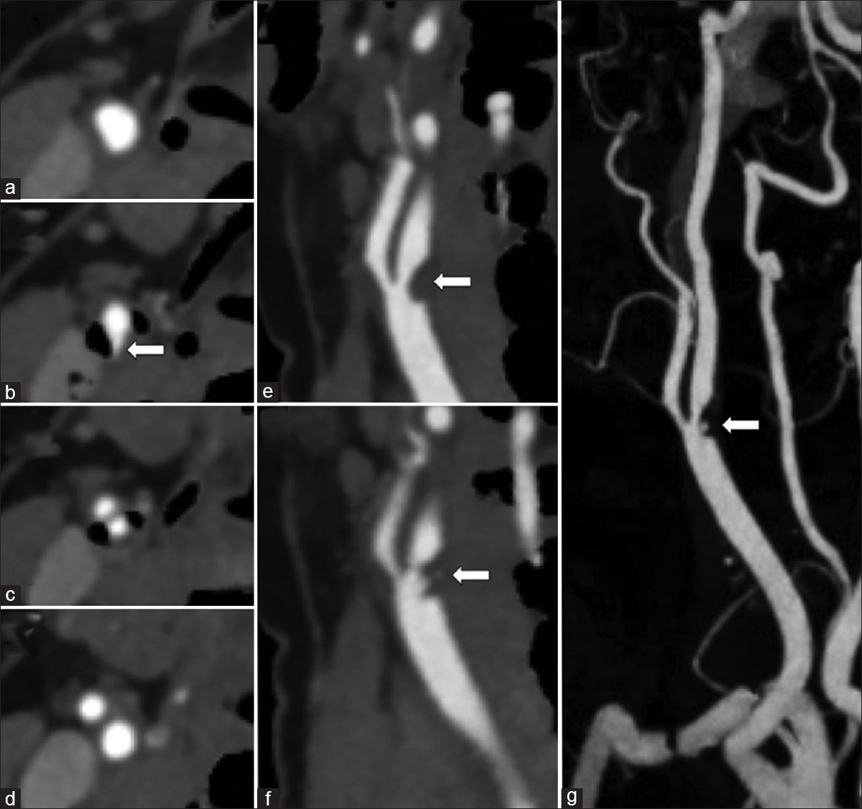 A 38-year-old female with acute right middle cerebral artery ischemic stroke. Dual-energy computed tomography neck angiogram with automatic hard plaque subtraction uncovering a fissured soft plaque flanked by adjacent calcified hard plaque. Axial images (a-d) show mixed morphology plaque at the carotid bifurcation with fissuring of the soft plaque arising from the posterior wall (arrow). Oblique sagittal reformation demonstrates the raised soft plaque from the posterior wall (arrow, e) with an irregular central fissure (arrow, f). Rotation maximum intensity projections with automatic bone and hard plaque subtraction clearly display the fissured soft plaque (arrow, g).