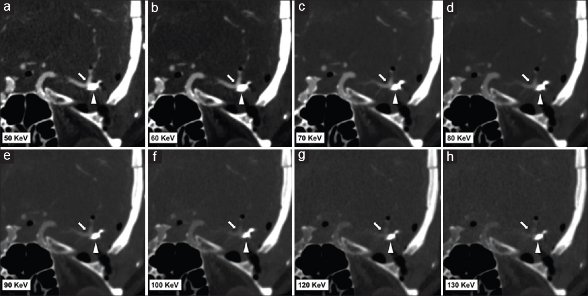 Representative dual-energy computed tomography angiogram images in a 49-year-old female post left middle cerebral artery aneurysm clipping. Images (a-h) are reformatted monoenergetic images at 50 keV, 60 keV, 70 keV, 80 keV, 90 keV, 100 keV, 120 KeV, and 130 keV. All images (a-h) set the same window width and level. Beam hardening artifact is reduced at 100-130 keV; however, at higher KeV, the contrast attenuation of the vessel is reduced.