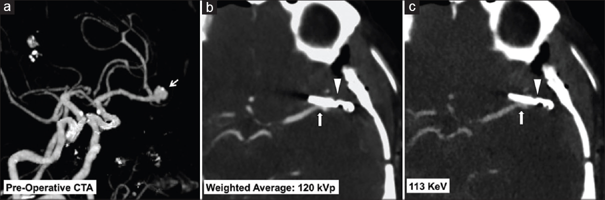 A 49-year-old female with a left middle cerebral artery bifurcation aneurysm treated with clipping. Preoperative dual-energy computed tomography angiogram maximum intensity projections image (a) shows a left middle cerebral artery aneurysm at the M1/M2 junction (arrow). Immediate postoperative dual-energy computed tomography angiogram weighted average 120 KVp image (b) and virtual monoenergetic 113 KeV image (c) show the aneurysm clip (arrow head) with improved metal artifact reduction and resolution of the adjacent vessel lumen using the virtual monoenergetic images (arrow, c).