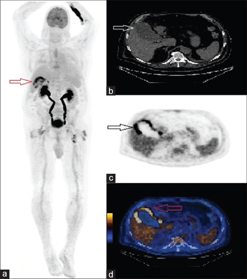 A 69-year-old male developed low-grade fevers and leukocytosis, after ascending aortic aneurysm repair with aortic valve replacement. (a) Fluorodeoxyglucose-positron emission tomography/computed tomography maximum intensity projection image shows no signs of infection around the aorta but increased metabolic activity around the gallbladder (arrow). (b) Axial view computed tomography image shows a distended gallbladder with mild pericholecystic fat stranding (arrow). (c) Fluorodeoxyglucose positron emission tomography image and (d) hybrid fluorodeoxyglucose-positron emission tomography/computed tomography, axial views, show increased tracer uptake in the wall of the gallbladder, with no uptake in the lumen (arrows).