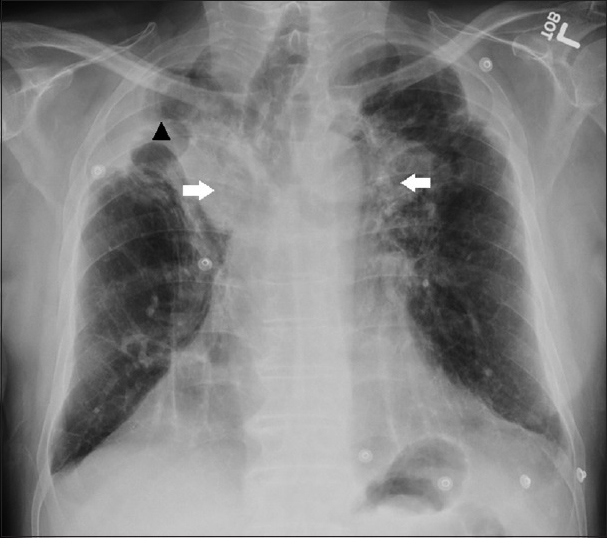 A 71-year-old man with a history of chronic obstructive pulmonary disease, pulmonary hypertension, and prior pulmonary tuberculosis infection presenting with progressive dyspnea, diagnosed with tuberculosis-associated fibrosing mediastinitis. Chest posteroanterior radiograph showing bilateral peri-hilar soft tissue densities (white arrows) with right apical, pleural thickening and volume loss (black arrow head).