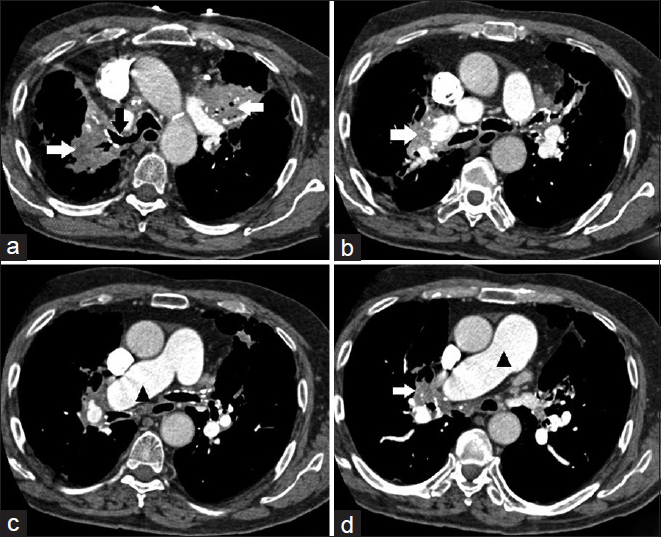 A 71-year-old man with a history of chronic obstructive pulmonary disease, pulmonary hypertension, and prior pulmonary tuberculosis infection presenting with progressive dyspnea, diagnosed with tuberculosis-associated fibrosing mediastinitis. Contrast-enhanced chest computed tomography, soft tissue window. (a-d) Demonstrates ill-defined, infiltrative bilateral hilar soft tissue densities with calcifications (white arrows); enlargement of the main and right pulmonary artery (black arrow heads); and irregular narrowing of the right mainstem and upper lobe bronchi (black arrow).