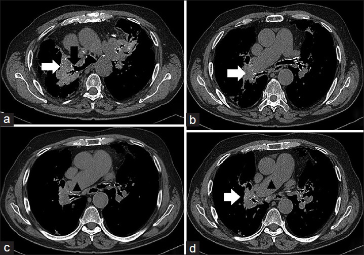 A 71-year-old man with a history of chronic obstructive pulmonary disease, pulmonary hypertension, and prior pulmonary tuberculosis infection presenting with progressive dyspnea, diagnosed with tuberculosis-associated fibrosing mediastinitis. Noncontrast enhanced computed tomography chest, soft tissue window, from 3-years prior. (a-d) Demonstrating ill-defined, infiltrative bilateral hilar soft tissue densities with calcifications (white arrows); enlargement of the main and right pulmonary artery (black arrow heads); and irregular narrowing of the right mainstem and upper lobe bronchi (black arrow).