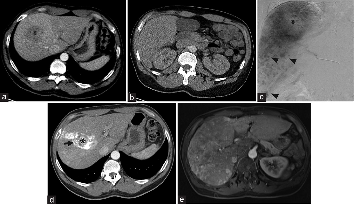 Angiographic findings contradictory to those on computed tomography. (a) Computed tomography demonstrated a 5.1-cm right liver mass, presumed hepatocellular carcinoma (black asterisk) in a 55-year-old male with hepatitis B virus cirrhosis. (b) No tumors were identified on computed tomography in the inferior right hepatic lobe. The original plan was for selective transarterial chemoembolization. (c) Angiography performed within 1 month of the computed tomography revealed a great number of small amorphous hypervascular nodules scattered in the inferior half of the right liver (black arrowheads). Only the dominant 5.1-cm right liver mass (black asterisk) was treated with transarterial chemoembolization. (d) Computed tomography 4 weeks later showed no tumors beyond the lipiodol-staining (arrow) of the dominant, embolized tumor (black asterisk). (e) However, magnetic resonance imaging 1 year later showed extensive multifocal and infiltrative hepatocellular carcinoma in the right liver with osseous metastases. No further liver therapy was performed, and the bone metastases (not shown) were treated with palliative radiation therapy.