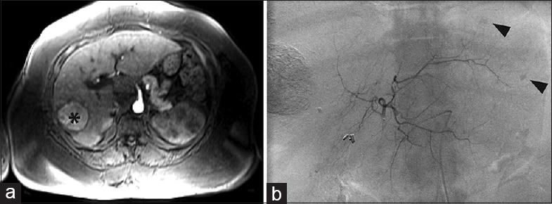 Additional lesions requiring additional treatment session. (a) Magnetic resonance imaging of a 59-year-old female with hepatitis C virus cirrhosis demonstrated a 5 cm hepatocellular carcinoma in liver segment 5 (black asterisk) with possible satellite nodules. The original plan was selective transarterial chemoembolization of the 5 cm mass. (b) Left hepatic angiography within 2 weeks of the magnetic resonance imaging showed two subcentimeter hypervascular nodules in segment 2 (black arrowheads) and a hypervascular focus in segment 7/8 that required a second transarterial chemoembolization procedure.