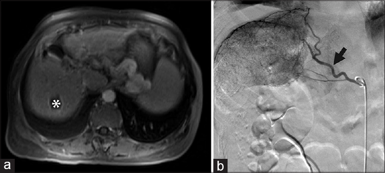 (a) Magnetic resonance imaging of a 62-year-old female with hepatitis B virus disease and prior transarterial chemoembolization of hepatocellular carcinoma in segments 4A and 7 showed no new tumors and an embolization cavity (white asterisk) without evidence of residual disease. However, rising alpha-fetoprotein prompted angiographic evaluation. (b) On angiography performed within 1 month of the magnetic resonance imaging, abnormal hypervascularity was identified near hepatic dome, in the region of the previously treated segment 7 tumor, supplied by subsegmental hepatic arterial branches and right inferior phrenic artery (black arrow) branches. Transarterial chemoembolization was performed via these branches. Two months following transarterial chemoembolization, alpha-fetoprotein returned to normal.