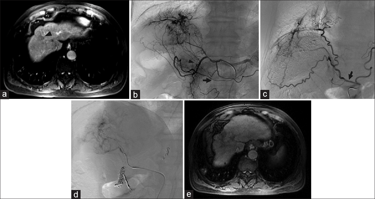 Recruitment of inferior phrenic artery and branch of the dorsal pancreatic artery. (a) Magnetic resonance imaging showed a new segment eight hepatocellular carcinoma (arrowhead) in a 70-year-old male with a history of chronic hepatitis B virus cirrhosis and hepatocellular carcinoma and prior transarterial chemoembolization and ablation procedures. The plan was transarterial radioembolization to the lesion. (b) Angiography revealed much more extensive disease than seen on magnetic resonance imaging showing that the arterial supply arose not only from the right hepatic branches but also a variant right lateral branch of the dorsal pancreatic artery (black arrowhead) arising from the common hepatic artery, branches of the gastroduodenal artery (black arrow) and (c) the right inferior phrenic artery (black arrow) with shunting to the pulmonary circulation. (d) During yttrium-90 mapping, embolization of the right inferior phrenic, gastroduodenal, and right gastric artery was performed, to allow for redistribution solely via the right hepatic where transarterial radioembolization was then performed. (e) Magnetic resonance imaging 3 months later showed no residual disease.