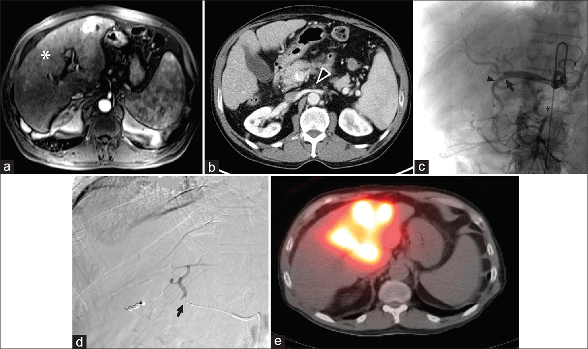 Superior mesenteric artery occlusion precluding gastroduodenal artery embolization during transarterial radioembolization. (a) Magnetic resonance imaging showed multifocal bilobar hepatocellular carcinoma (white asterisk) in a 71-year-old male. (b) Superior mesenteric artery occlusion (arrowhead) was also noted on computed tomography. (c) Angiography demonstrated that the bowel was supplied by the celiac artery via the gastroduodenal artery, via the pancreaticoduodenal arcade, precluding gastroduodenal artery embolization. However, the right and left hepatic arteries and gastroduodenal artery originated from the common hepatic artery in a trifurcation (black arrow), raising concern for nontarget embolization to the bowel from yttrium-90 embolization of either hepatic artery since the gastroduodenal artery (black arrowhead) supplied the superior mesenteric artery distribution due to superior mesenteric artery occlusion (black asterisk). (d) Therefore, a Surefire catheter (Surefire Medical Inc., Westminster, CO, USA; black arrow) was used to prevent retrograde flow of the yttrium-90 embolic agent during embolization. (e) Single-photon emission computed tomography imaging showed delivery to the liver parenchyma without activity in the bowel.