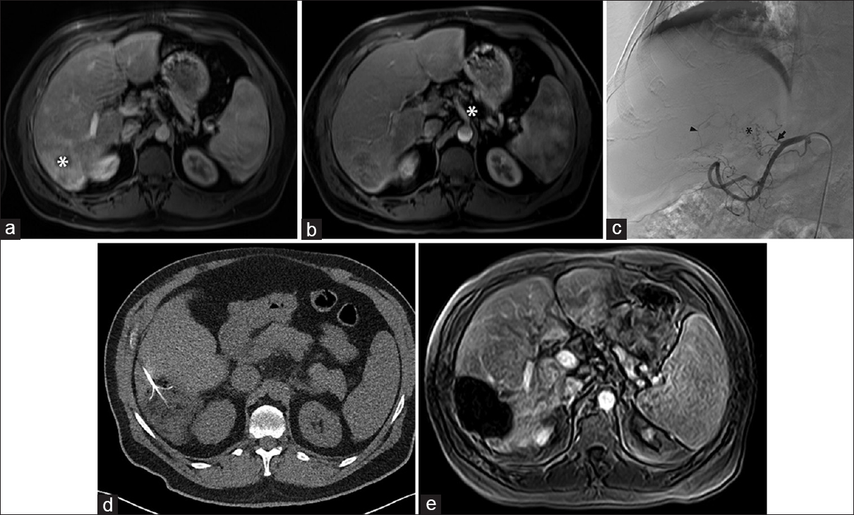 Transarterial therapy, not possible. (a) Magnetic resonance imaging demonstrated hepatocellular carcinoma (white asterisk) in a 59-year-old male with a transplanted liver, performed 17 years earlier, for hepatitis C virus cirrhosis. (b) Celiac axis (white asterisk) appeared widely patent, and the original plan was for transarterial radioembolization. (c) However, angiography demonstrated chronic obstruction of the proper hepatic artery (arrow) precluding transarterial therapy that had not been appreciated on the pre procedure magnetic resonance imaging. The liver was supplied by extensive but fine collateral vessels from the left gastric and gastroduodenal artery branches (black arrowhead), as well as branches (black asterisk) from the remaining proper hepatic arterial stump (black arrow). (d) The patient later underwent RFA of the tumor. (e) Magnetic resonance imaging 4 weeks later showed no residual disease.