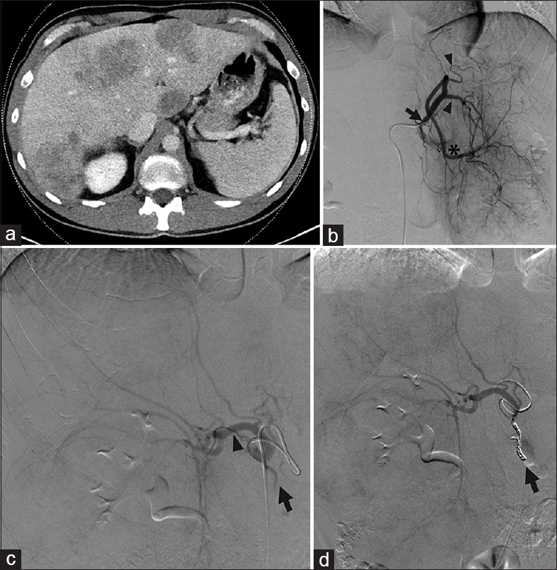 Replaced right hepatic artery. (a) Computed tomography showed tumors in both hepatic lobes in a 49-year-old male with metastatic colon cancer. Arterial phase images were not obtained. The pre procedure treatment plan was for transarterial radioembolization. (b) During mapping, angiography showed a left gastrohepatic trunk (black arrow) with multiple gastric branches (black arrowheads) arising before the left hepatic artery (black asterisk). There are a marked enlargement and inferior deviation of the left hepatic lobe due to large masses. (c) A replaced right hepatic artery (black arrowhead) from the superior mesenteric artery was not appreciated on pre procedure imaging but identified angiographically. The gastroduodenal artery (black arrow) originated from the right hepatic artery (black arrowhead). (d) The gastroduodenal artery was coil embolized (black arrow). Yttrium-90 mapping of the left and right lobes was therefore performed by macroaggregated albumin infusion via two separate catheter placements.