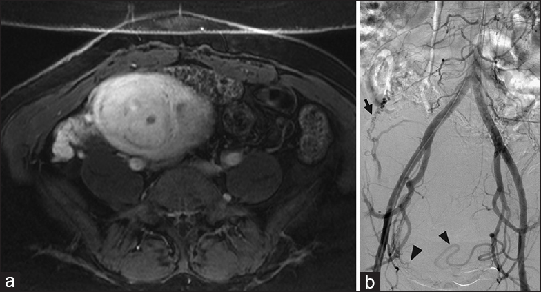 Ovarian artery supply to the uterus. (a) Contrast-enhanced T1-weighted magnetic resonance imaging demonstrates a fibroid uterus in a 48-year-old female with pelvic pain and menorrhagia. (b) Abdominopelvic aortogram demonstrates supply to the enlarged fibroid uterus from branches from the right and left uterine arteries (black arrowheads). In addition, the enlarged right ovarian artery (black arrow) supplies a portion of the superior uterus. All three vessels were embolized with particles, to assure clinical response.