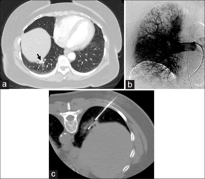 Pulmonary angiography excludes arteriovenous malformation. (a) A 64-year-old female with chronic obstructive pulmonary disease was found to have hypervascular right lower lobe lung nodules, with imaging features suggestive of arteriovenous malformations (black arrow). Contrast-enhanced computed tomography findings were considered suspicious enough to warrant a conventional angiogram and possible embolization. (b) Right pulmonary angiography demonstrated no evidence of dilated artery or early draining vein, excluding arteriovenous malformations. (c) Computed tomography-guided biopsy of a dominant nodule was then performed and revealed a diagnosis of nonsmall cell carcinoma.