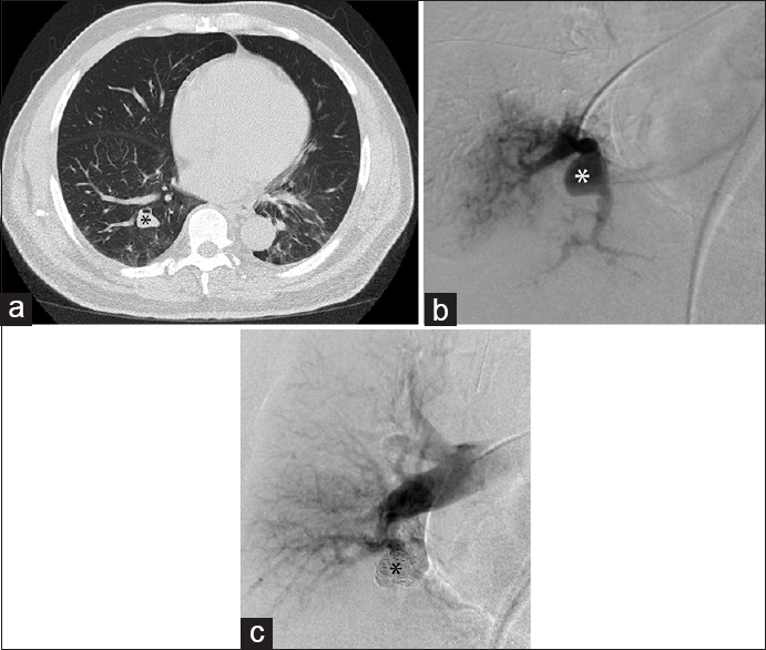 Pulmonary angiography excludes arteriovenous malformation and diagnoses pseudoaneurysm. (a) Chest computed tomography in a 70-year-old male demonstrates a right lower lobe pulmonary nodule (black asterisk) thought to represent an arteriovenous malformation. Computed tomography pulmonary angiogram was not performed, as the findings were considered suspicious enough to warrant conventional angiography. (b) Right lower lobe segmental pulmonary arteriogram demonstrated a pseudoaneurysm (white asterisk) of the vessel perfusing the medial portion of the base of the right lower lobe, without a draining vein to suggest an arteriovenous malformation. (c) Coil embolization (black asterisk) of the pseudoaneurysm was performed.