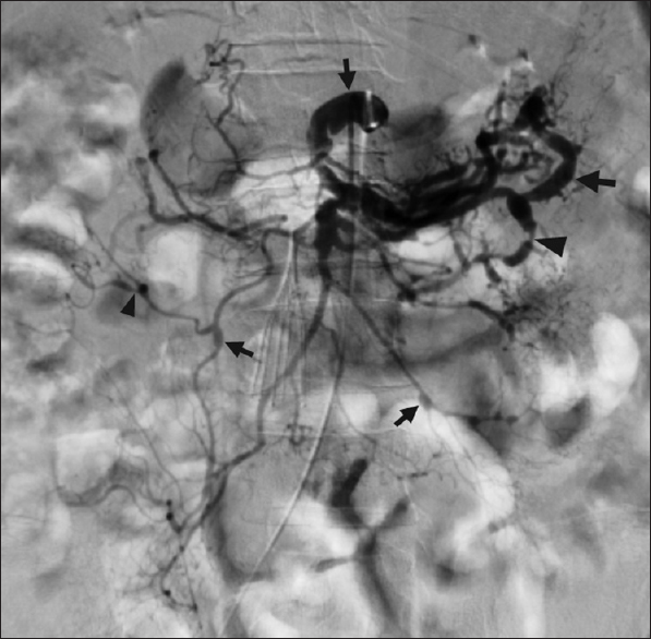 Mesenteric arteriography diagnoses segmental arterial mediolysis. A 62 year old man with spinal cord compression from a thoracic tumor developed massive hemorrhage following surgical decompression. The patient required numerous transfusions and aggressive vasopressor support. He subsequently developed massive melena, the source of which was unclear on endoscopy. Celiac and superior mesenteric arteriography unexpectedly demonstrated scattered stenoses (black arrowheads), aneurysms (black arrows), and arterial dissections, in a pattern consistent with segmental arterial mediolysis. The procedure was stopped, as it was now recognized that the patient was not amenable to endovascular intervention.