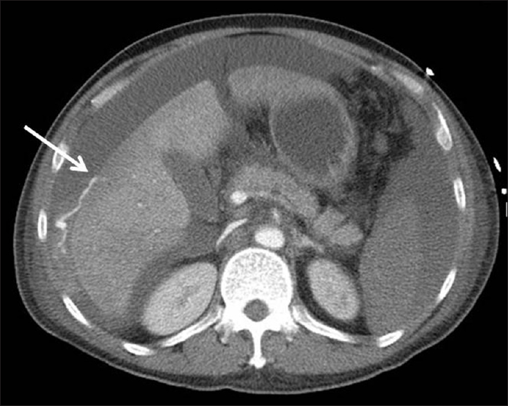 A 61-year-old man with shock after liver biopsy. Contrast enhanced computed tomography of the abdomen demonstrates massive hemoperitoneum and active contrast extravasation from the anterior surface of segment 5 of the liver (arrow).