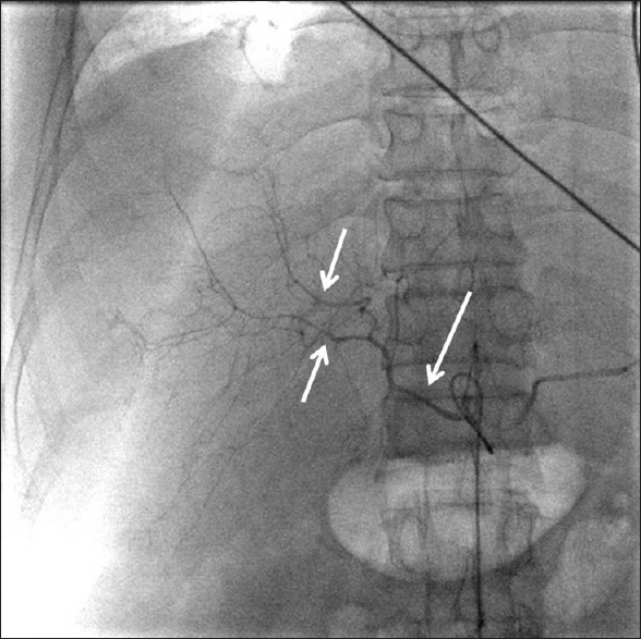 Celiac angiogram of the patient showed marked stenosis and tortuous course of the celiac trunk, common and main hepatic arteries, and the intrahepatic arteries (arrows).